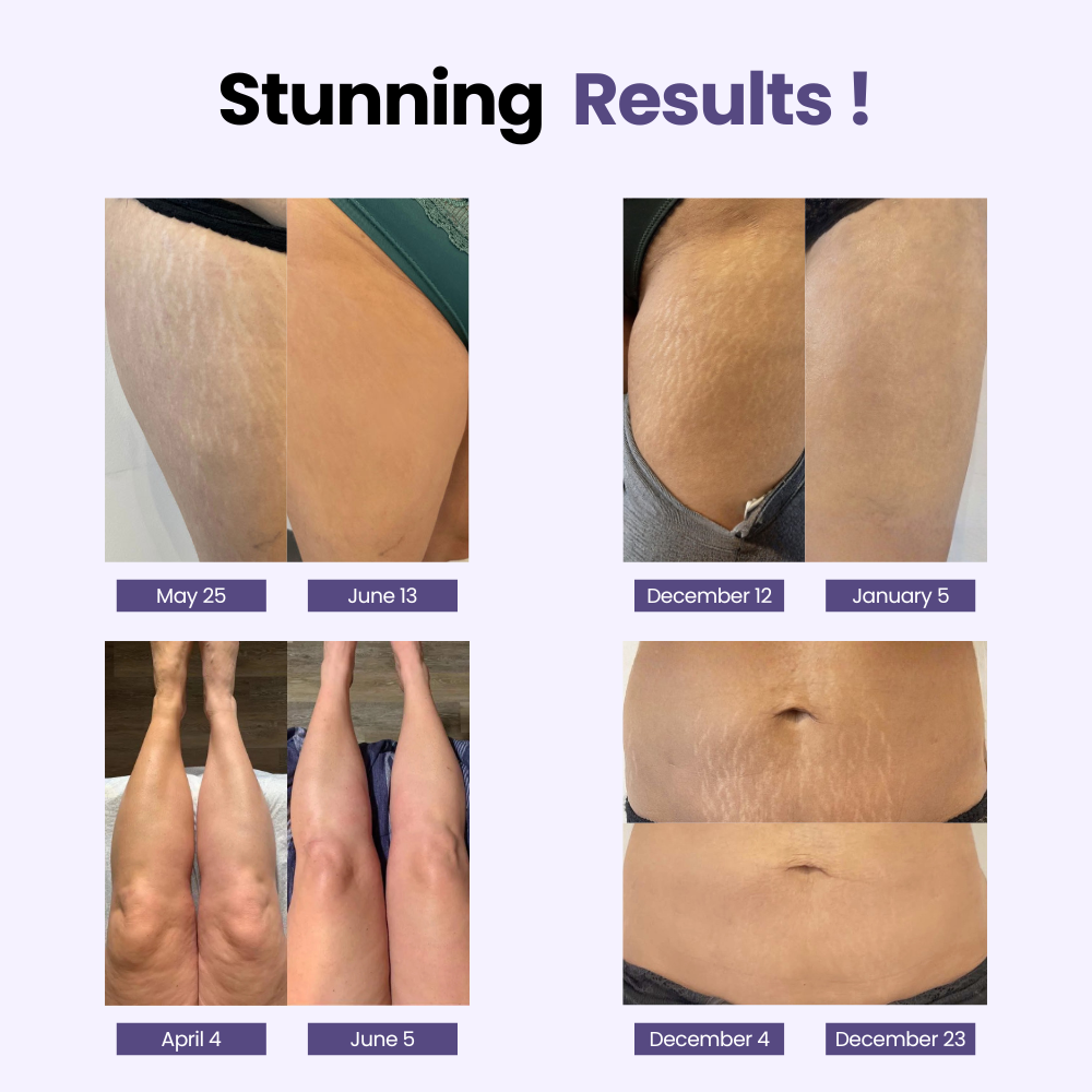 Nervalis Stretch Marks & Firming Cream